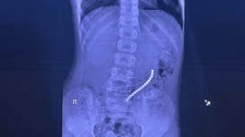 In the hospital of Irkutsk rescued a boy who swallowed 16 magnetic balls