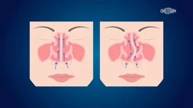 Когда необходимо оперировать искривленную носовую перегородку