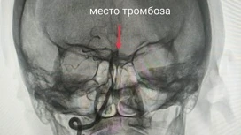 Ивановские медики провели уникальную операцию по удалению тромба