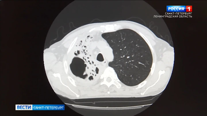 Вести. Санкт-Петербург В Петербурге рассказали о новой стратегии борьбы со смертоносным штаммом туберкулеза